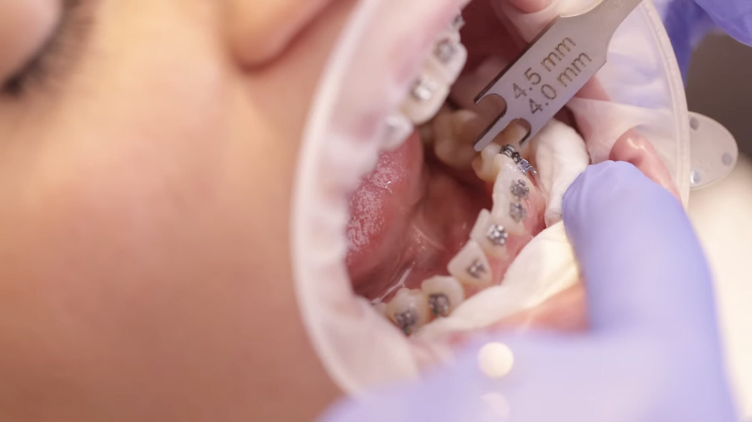 Ortodonta mierzy pozycję zamka ortodontycznego miarką milimetrową podczas zakładania aparatu stałego w Exclusive Dental Studio