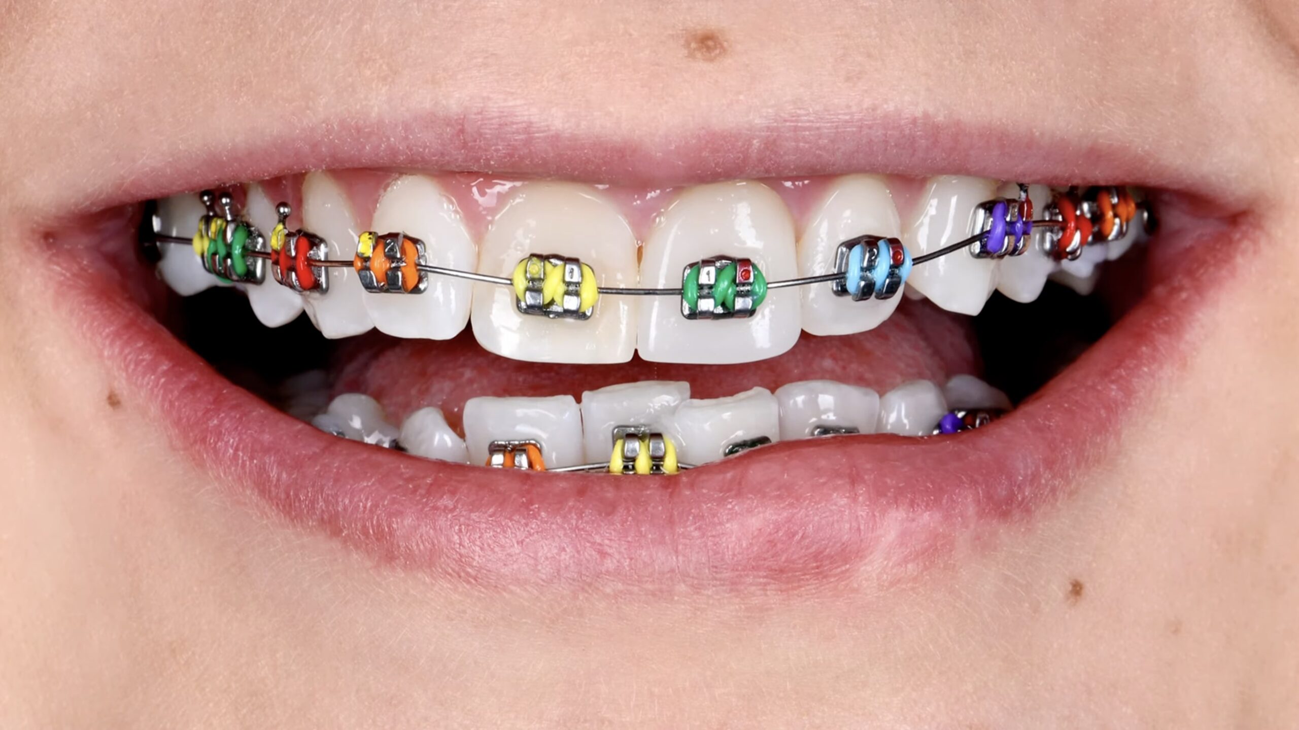 Gotowy aparat ortodontyczny z kolorowymi ligaturami w kolorach tęczy na górnym i dolnym łuku zębowym